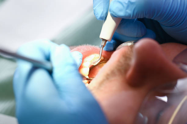 Best Emergency Tooth Extraction in Hasley Nyon, CA