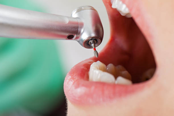 Best Urgent Care for Lost Fillings or Crowns in Hasley Nyon, CA